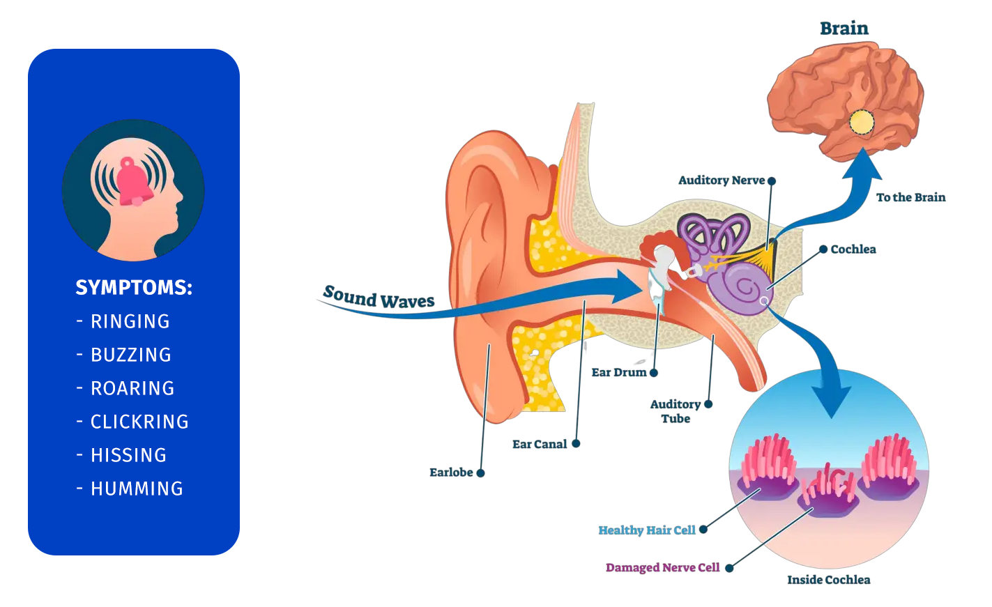 Tinnitus symptoms